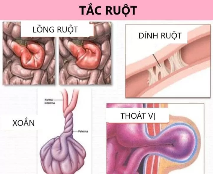 Các Phương Pháp Phòng Tránh Dính Ruột